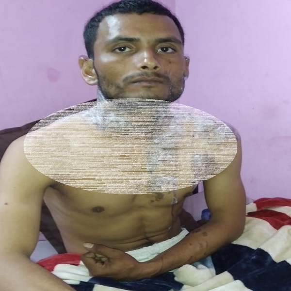 girl acide attack on boy in unnao in one sided love