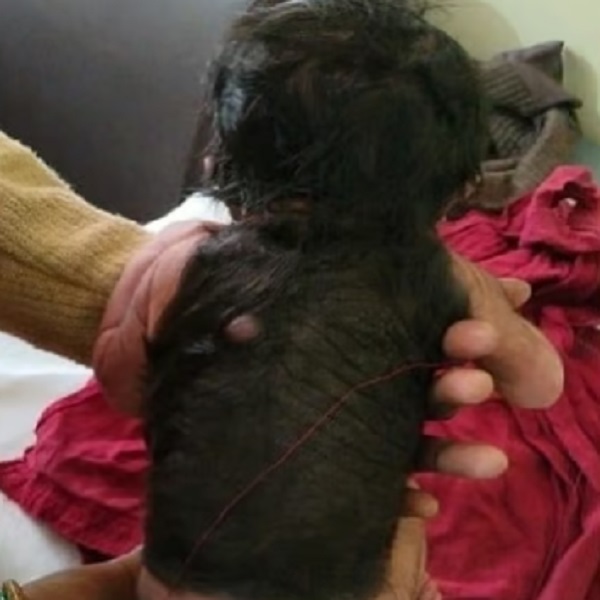 All surprised : woman gave birth to strange child, 70 percent of body covered with hair in Hardoi, this is disease 